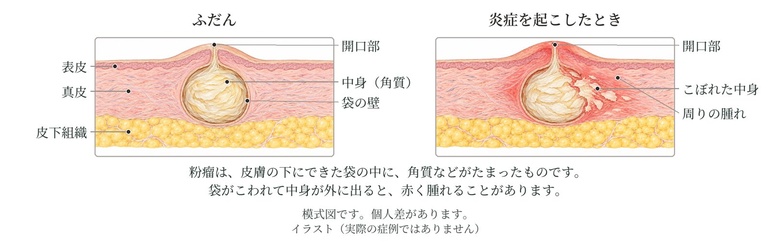 皮膚の断面の模式図。ふだんの粉瘤は、皮膚の下の袋の中に角質がたまり、表面に小さな開口部がある。炎症を起こすと、袋がこわれて中身がこぼれ、周りが赤く腫れる