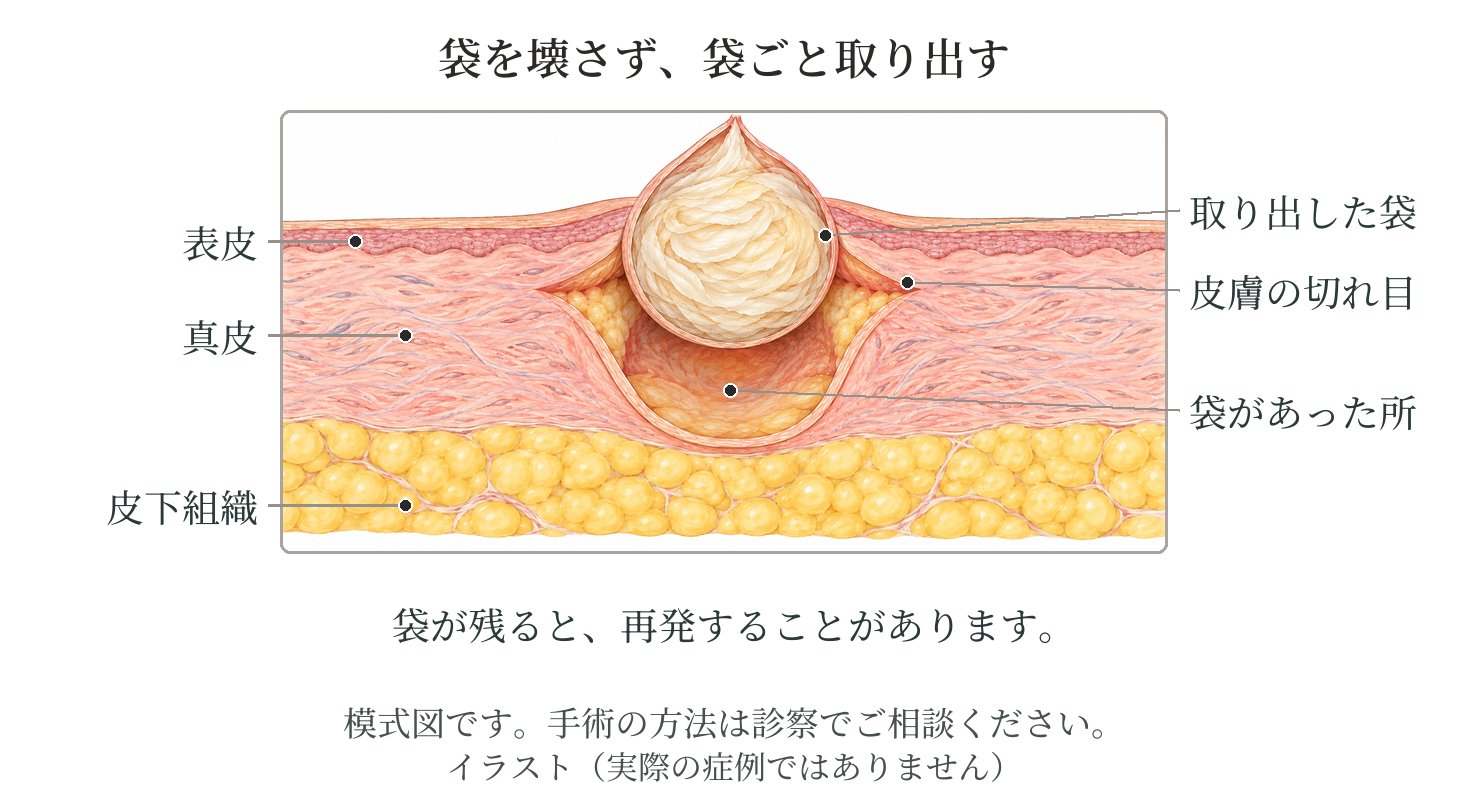 皮膚の断面の模式図。粉瘤の袋を壊さずに、袋ごと取り出す。袋が皮膚の下に残ると、再発することがある