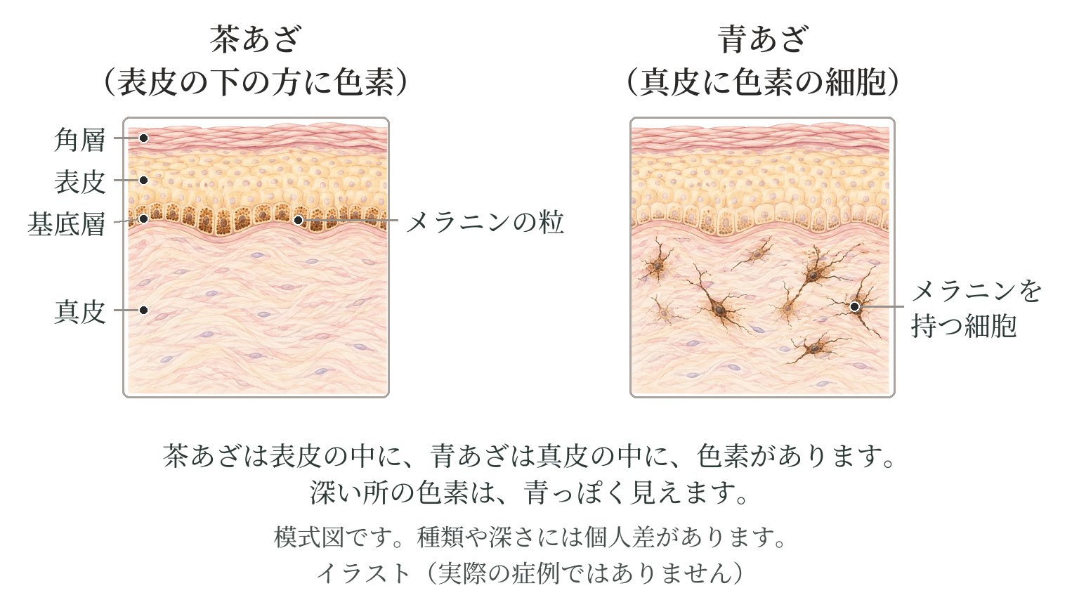 皮膚の断面の模式図。茶あざは表皮の下の方に色素がある。青あざは真皮にメラニンを持つ細胞が散らばっている