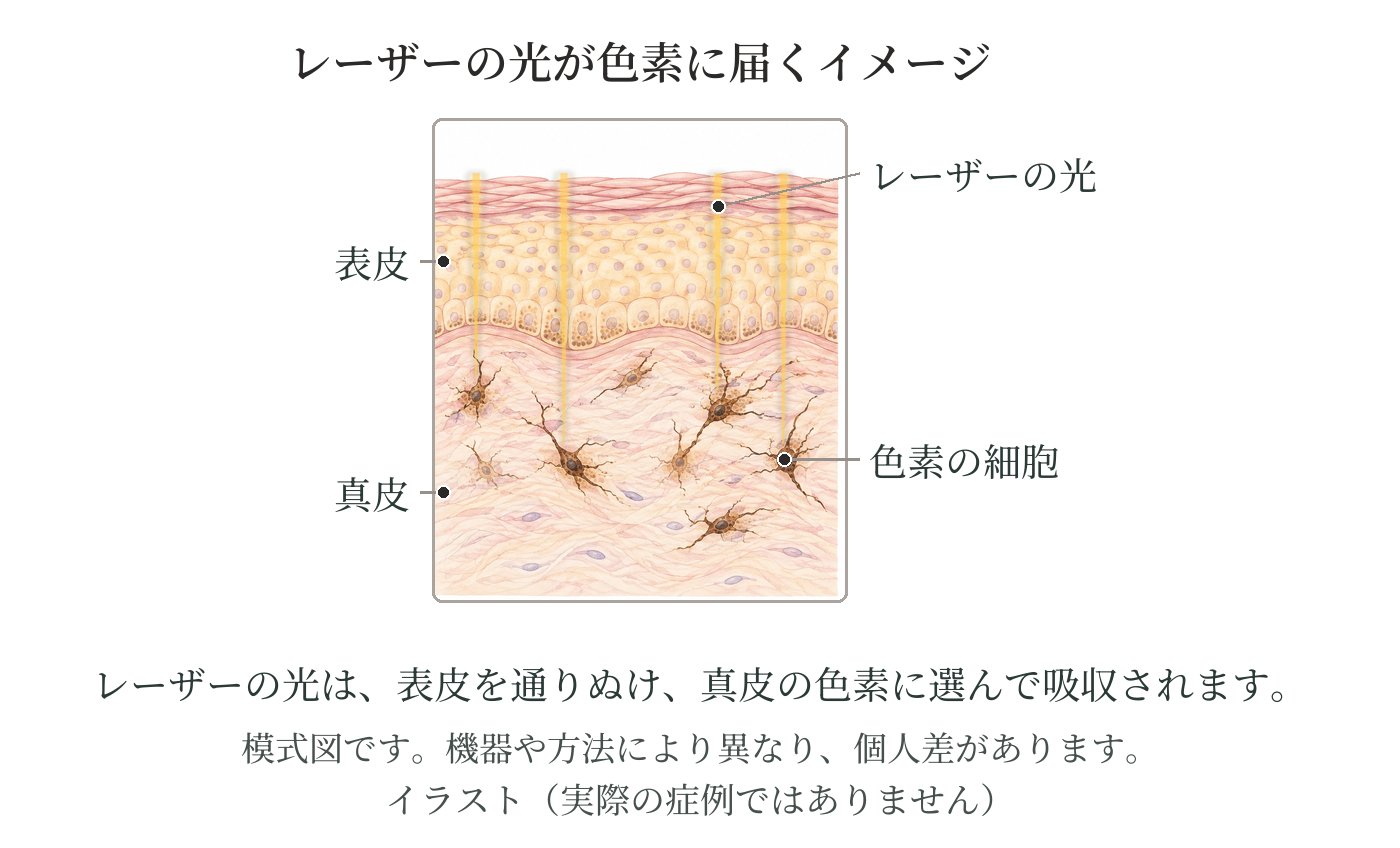 皮膚の断面の模式図。レーザーの光が表皮を通りぬけ、真皮にある色素の細胞に選んで吸収される