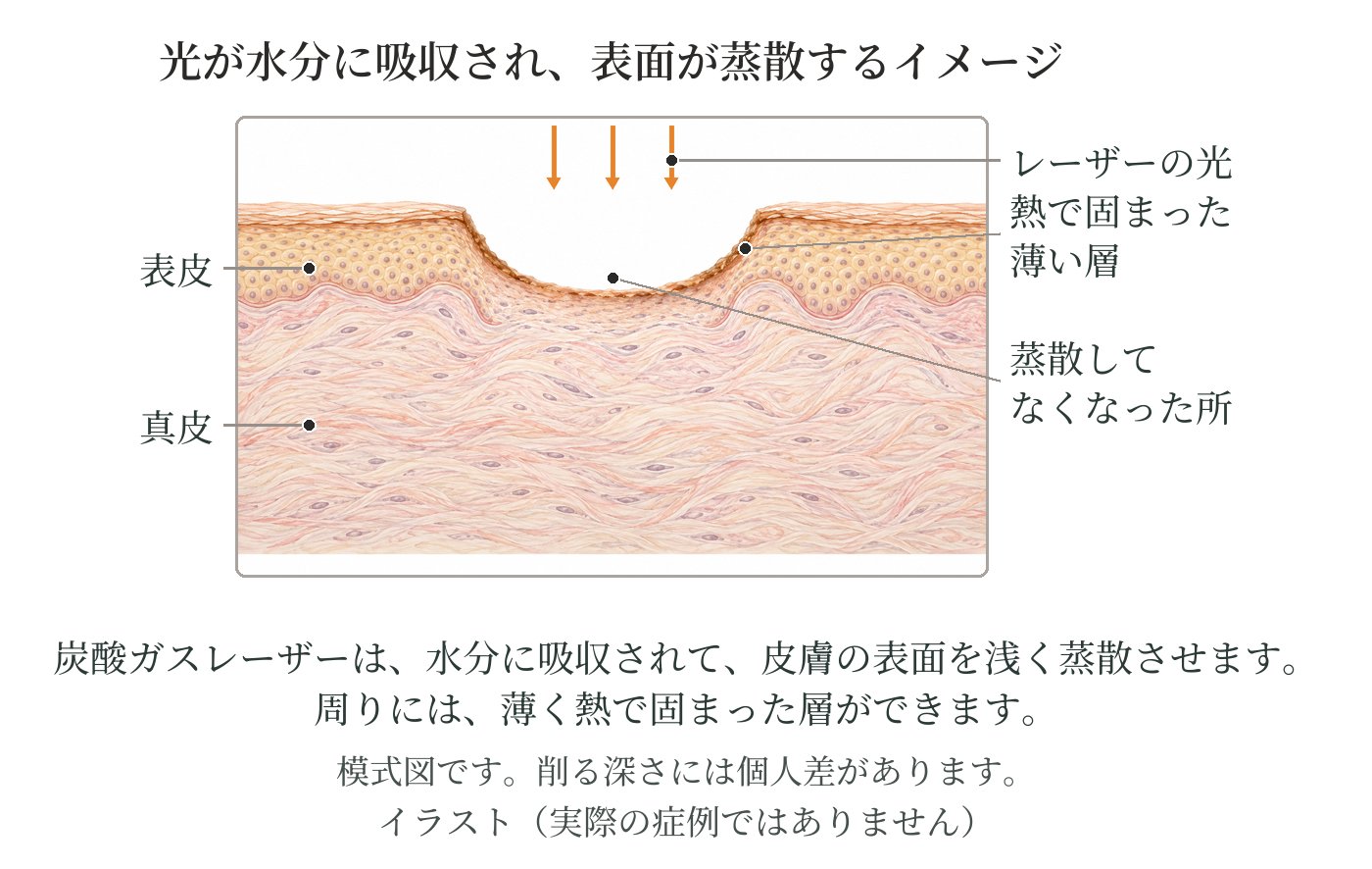 皮膚の断面の模式図。レーザーの光が水分に吸収されて皮膚の表面が浅く蒸散し、周りに熱で固まった薄い層ができる