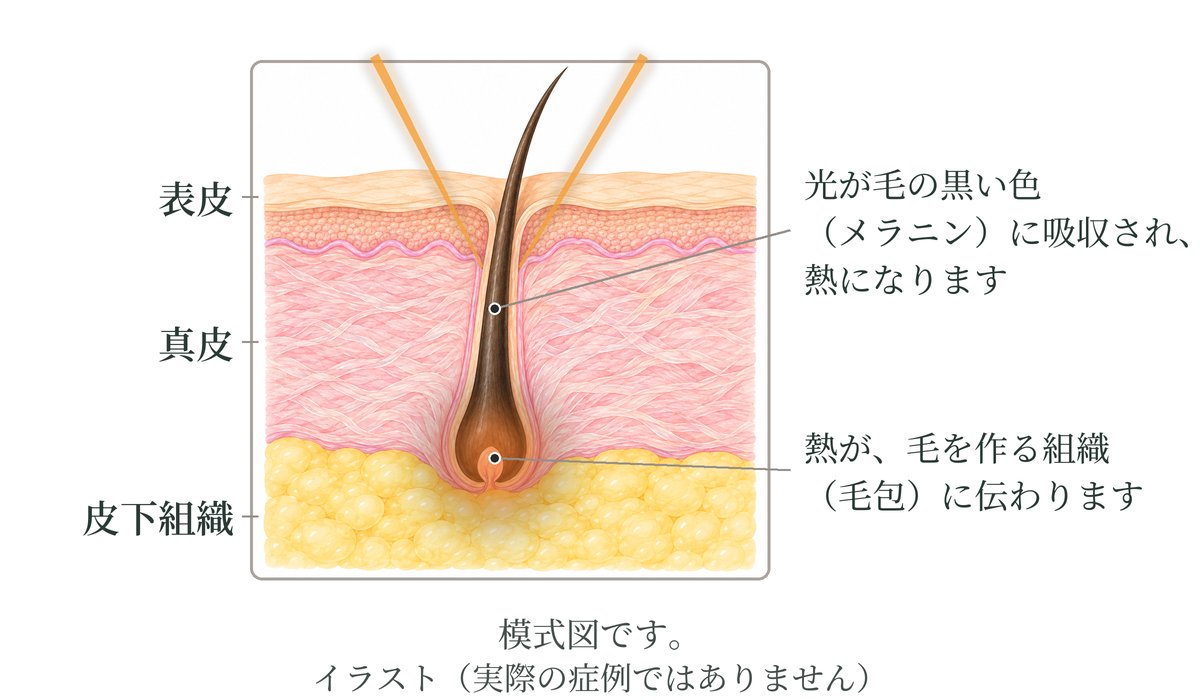 皮膚の断面の模式図。レーザーの光が毛の黒い色(メラニン)に吸収されて熱になり、その熱が毛を作る組織(毛包)に伝わる