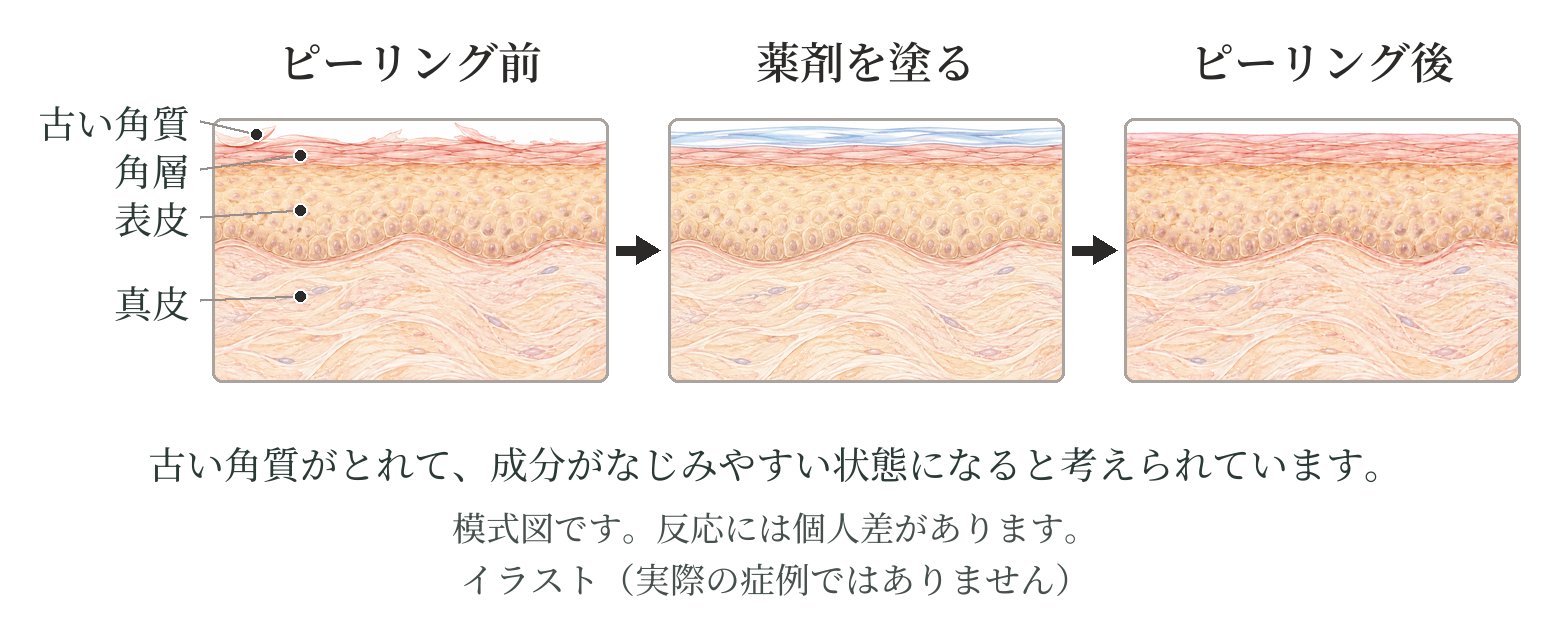 皮膚の断面の模式図。ピーリング前(古い角質がある)、薬剤を塗る、ピーリング後(古い角質がとれた肌の状態)の3つ