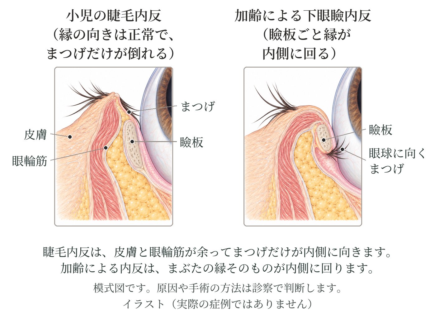 下まぶたの断面の模式図。睫毛内反はまぶたの縁の向きは正常でまつげだけが目の方へ倒れ、眼瞼内反はまぶたの縁ごと内側へ回る