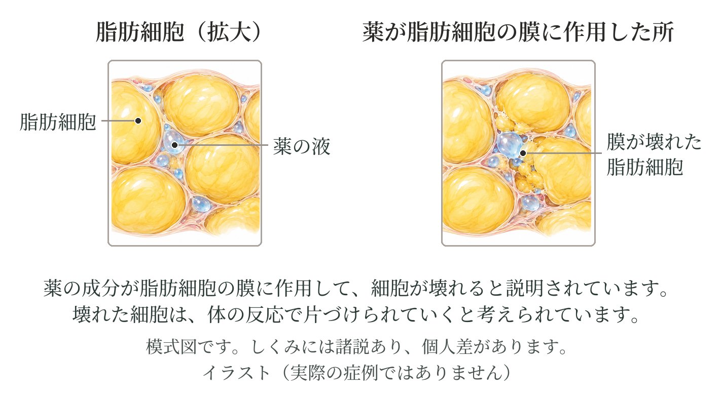 脂肪細胞の拡大の模式図。薬の液がはたらいて、脂肪細胞の膜が壊れた状態