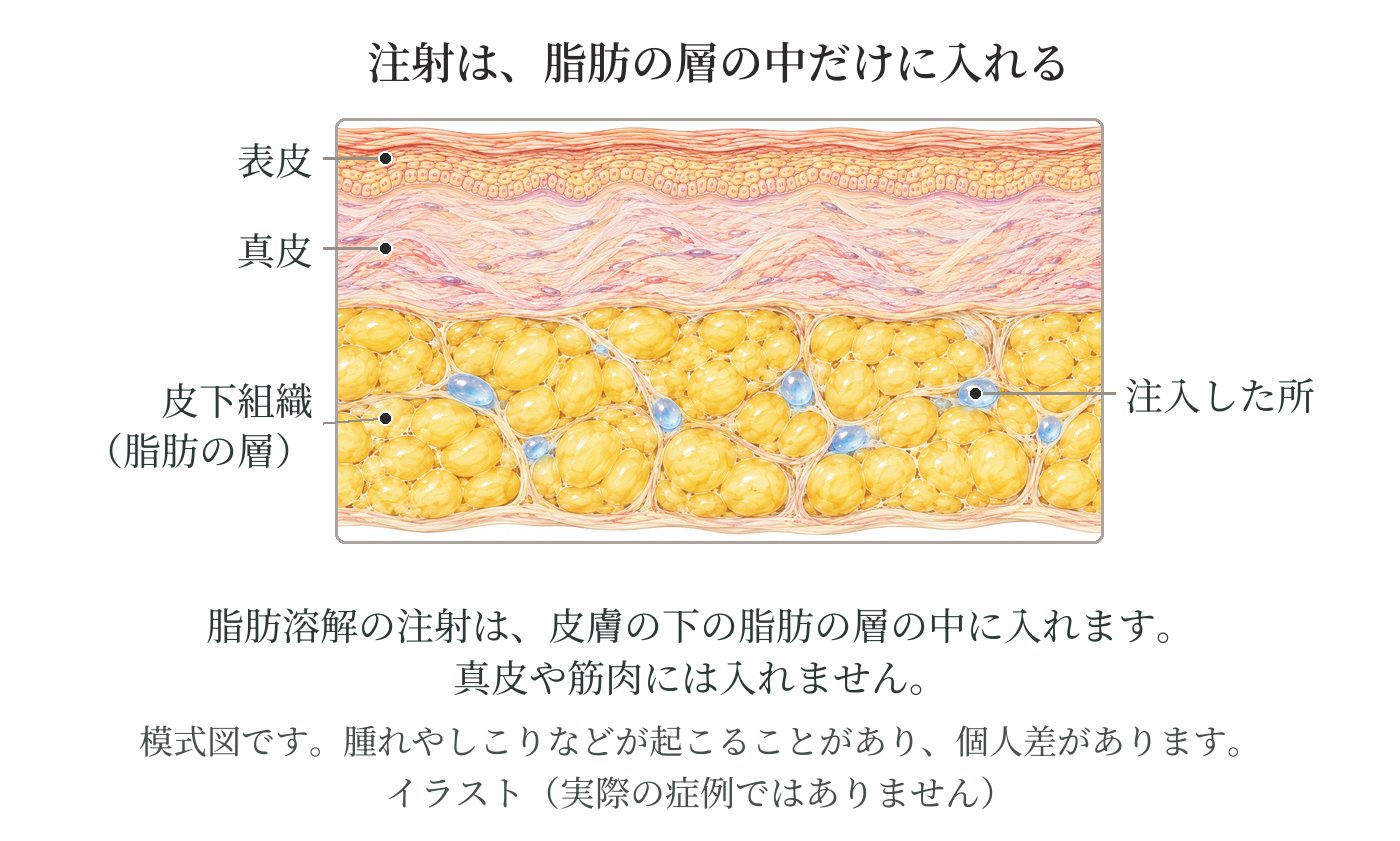 皮膚の断面の模式図。真皮と筋肉の間にある脂肪の層の中だけに注射する