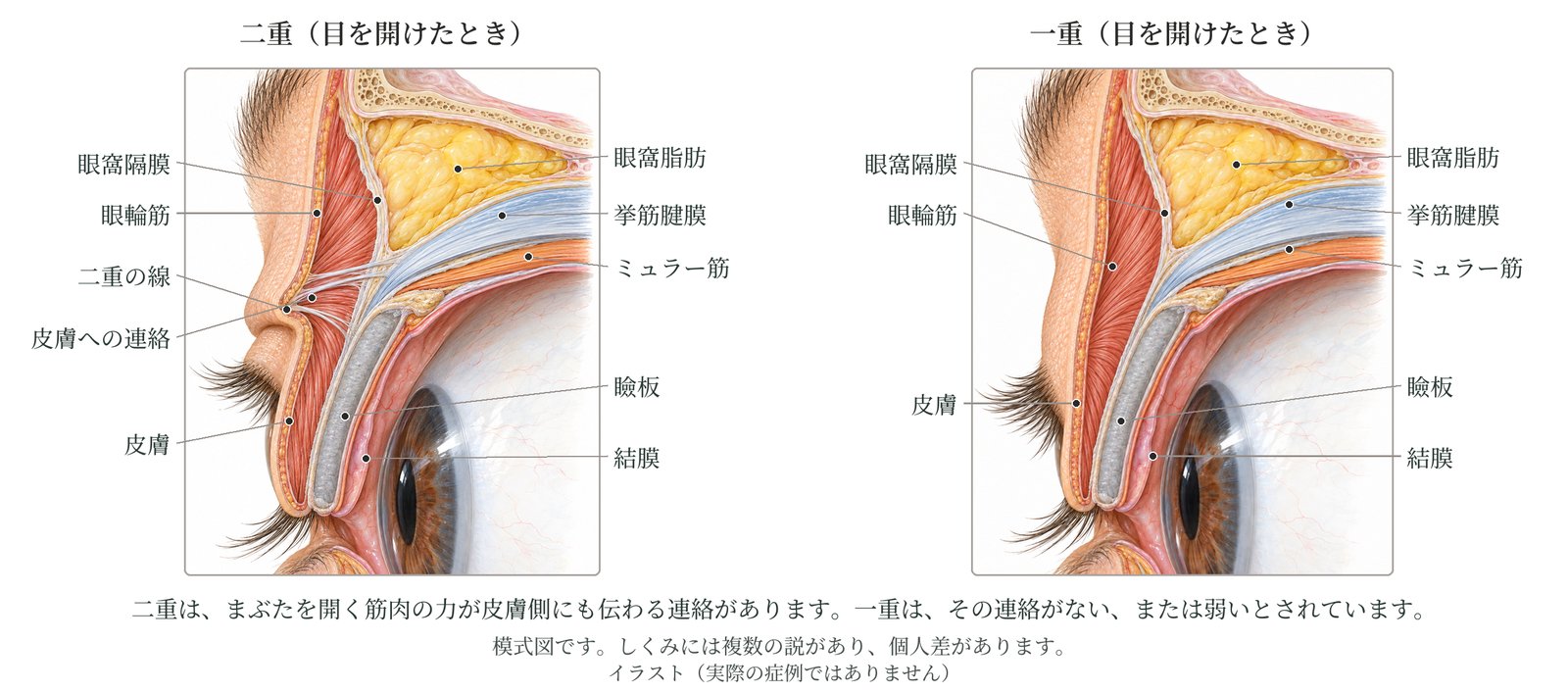 上まぶたの断面の模式図。二重のまぶたは、目を開ける筋肉の力が皮膚の側にも伝わるつながりがあり、目を開けると皮膚が内側に折れ込んで線ができる。一重のまぶたはそのつながりがない