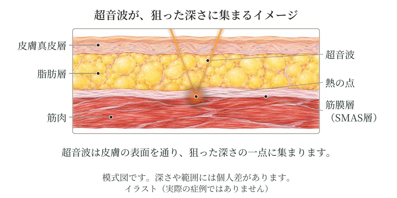 皮膚の断面の模式図。皮膚の表面から入った超音波が、脂肪の層を通って、筋膜の層(SMAS層)のあたりの一点に集まり、熱の点ができる
