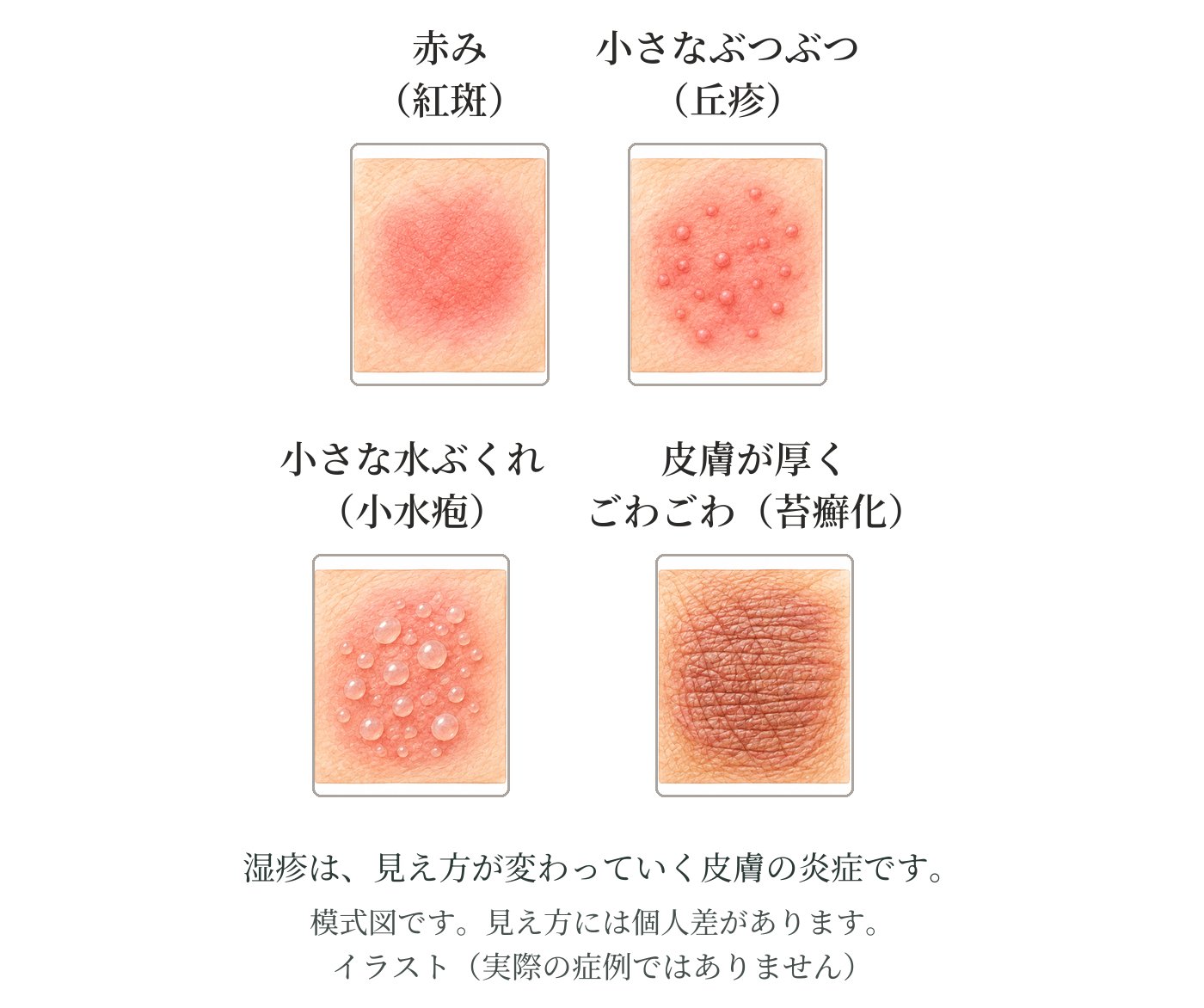 皮膚の表面のイラスト4つ。赤み(紅斑)・小さなぶつぶつ(丘疹)・小さな水ぶくれ(小水疱)・皮膚が厚くごわごわした状態(苔癬化)