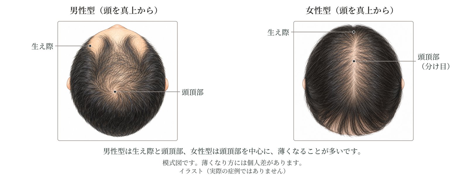 頭を上から見た模式図。男性型は額の生え際と頭のてっぺん、女性型は分け目を中心に頭頂部が広く薄くなる