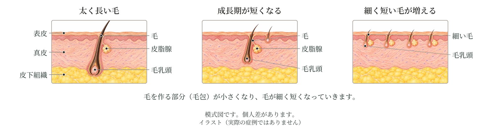 毛包の断面の模式図。太く長い毛から、成長期が短くなり、細く短い毛が増えていく様子