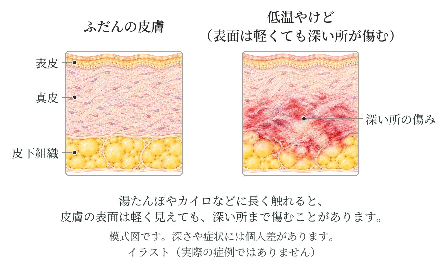 皮膚の断面の模式図2つ。左はふだんの皮膚、右は低温やけどで表面は軽く見えても深い所が傷んでいる皮膚